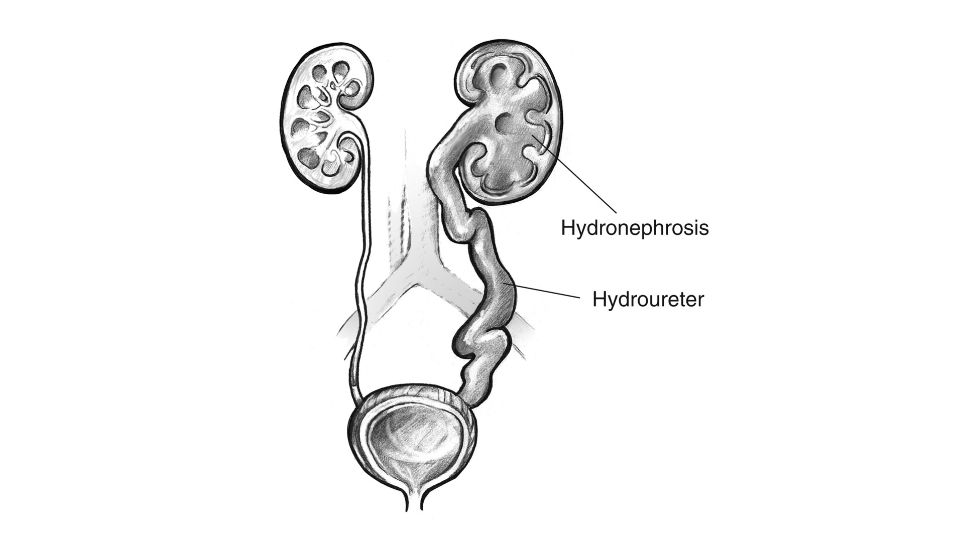 Hydronephrosis in Newborns - NIDDK