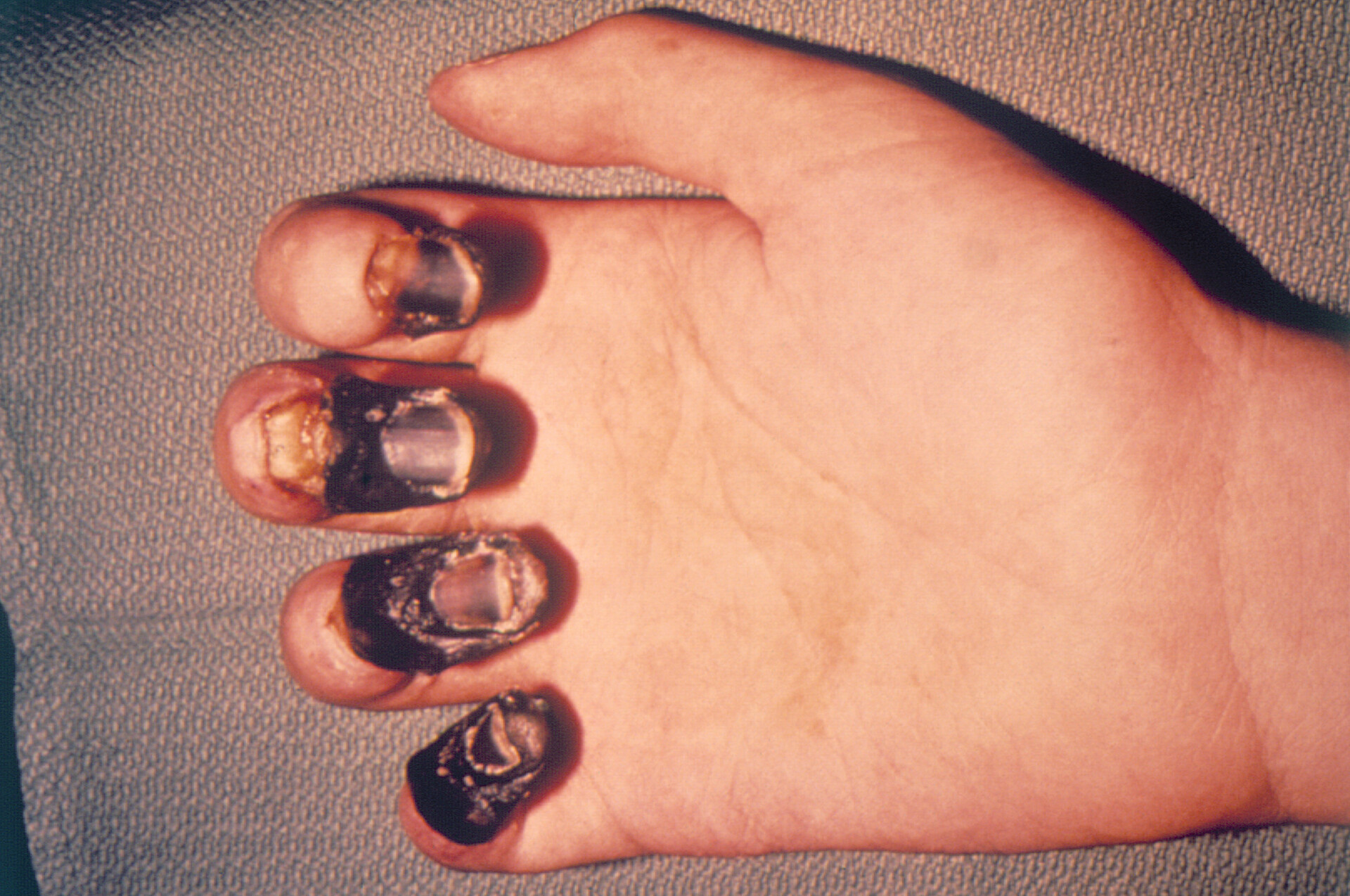 Internal Gangrene internal-gangrene