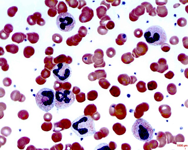 Thrombotic Thrombocytopenic Purpura Smear