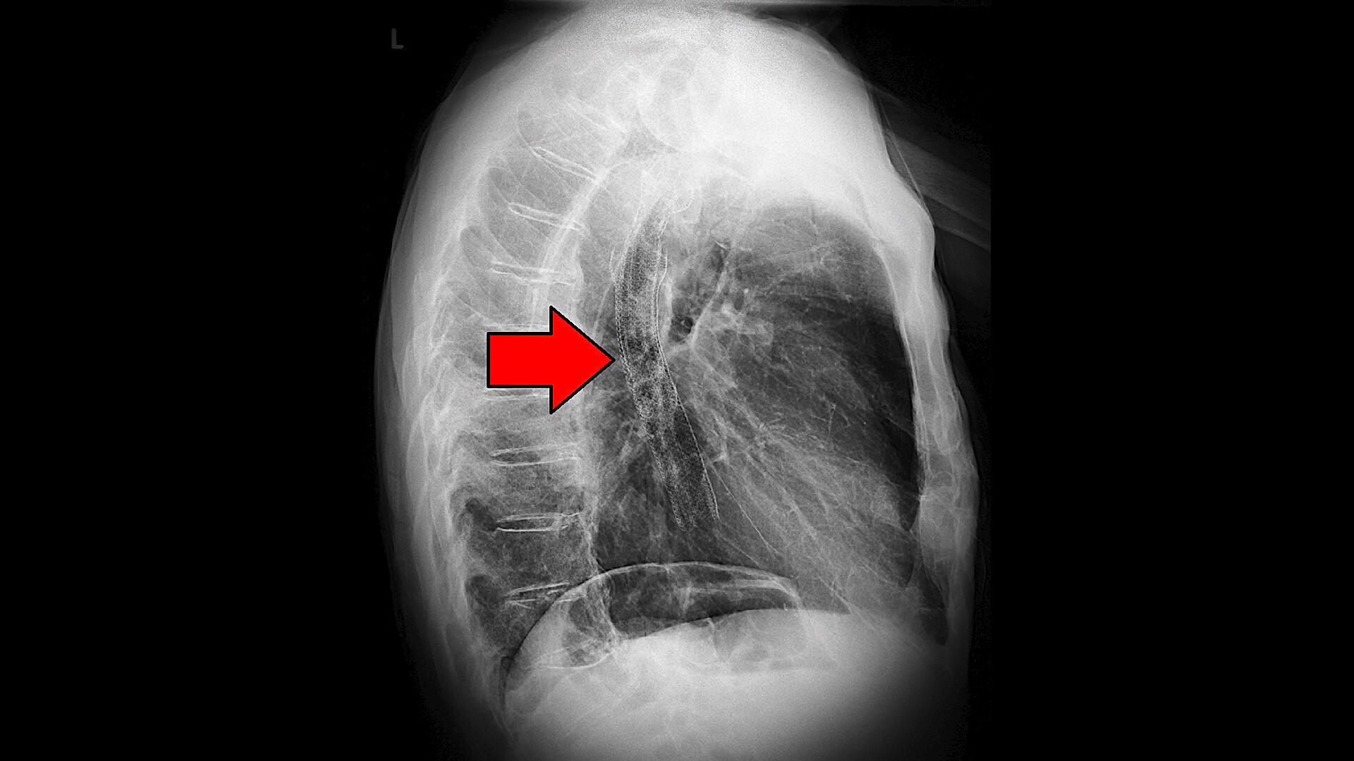 Esophageal Cancer Risk Factors Symptoms Treatment StoryMD