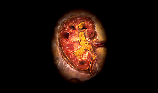 Primary Hyperoxaluria Type 1 - StoryMD