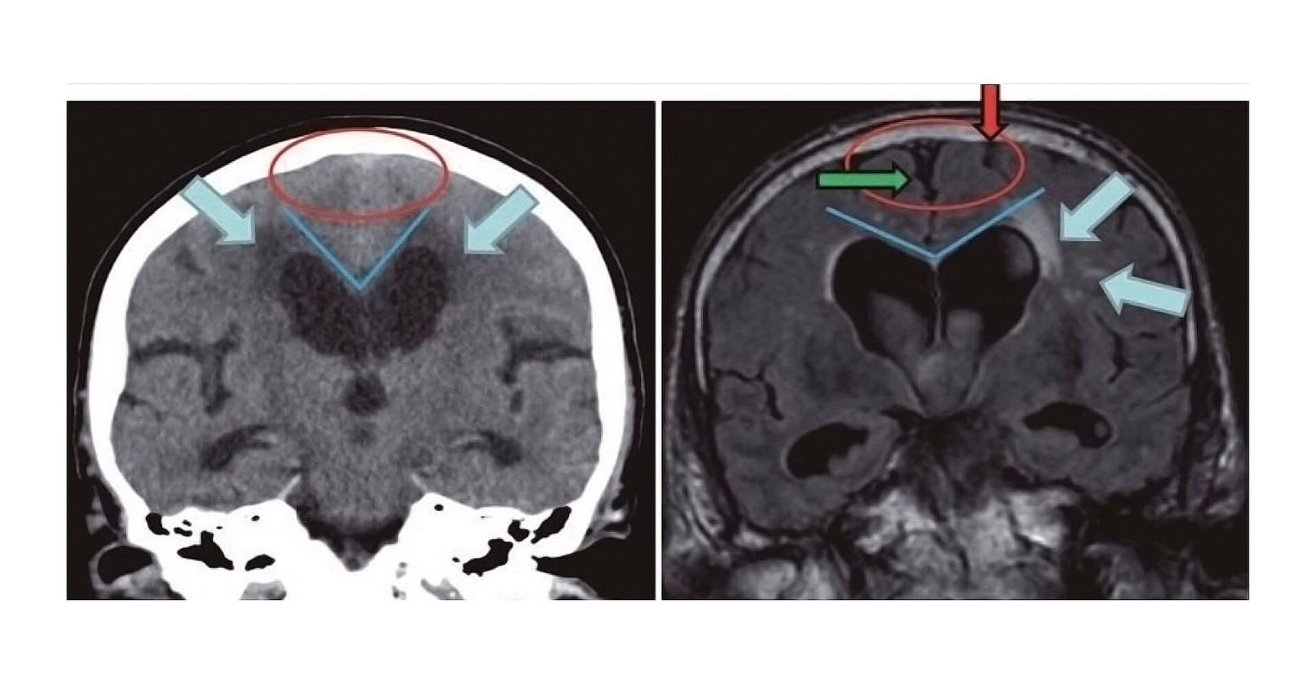 What Is Normal Pressure Hydrocephalus