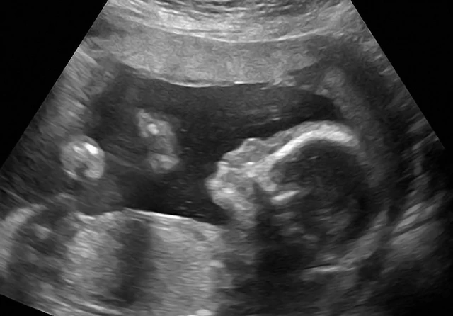 21 weeks ultrasound