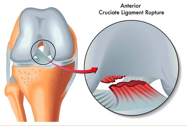 Anterior Cruciate Ligament Injury - Fast Facts and Glossary - StoryMD