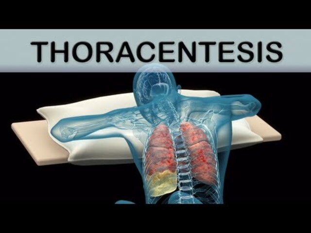 Thoracentesis - StoryMD