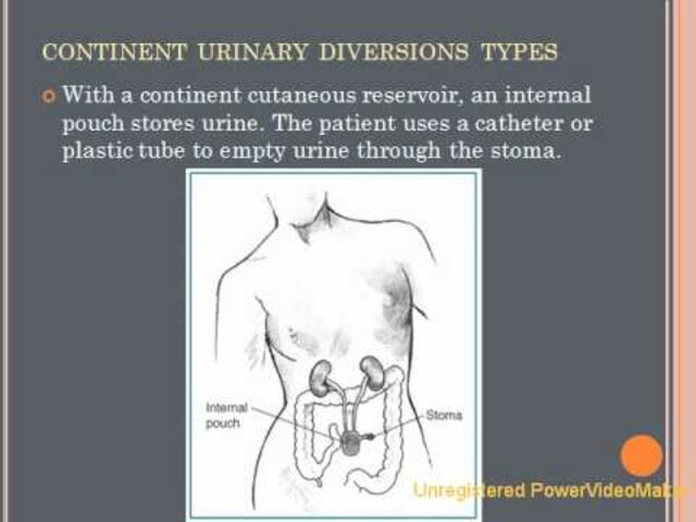Urinary Diversion - NIDDK