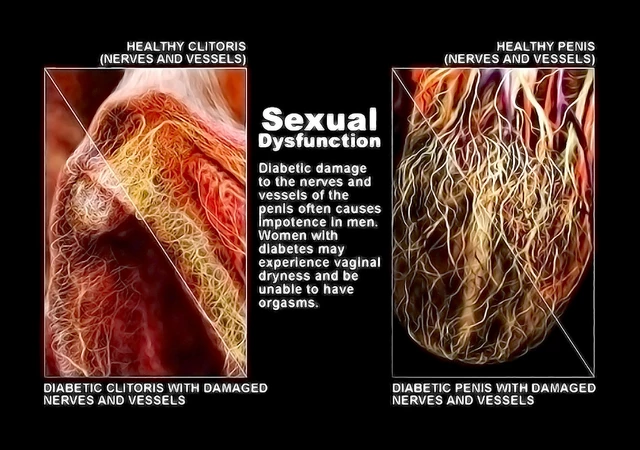 Diabetes and Erectile Dysfunction ED StoryMD