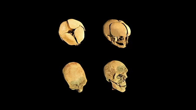 What Is Rubinstein-Taybi Syndrome? - StoryMD