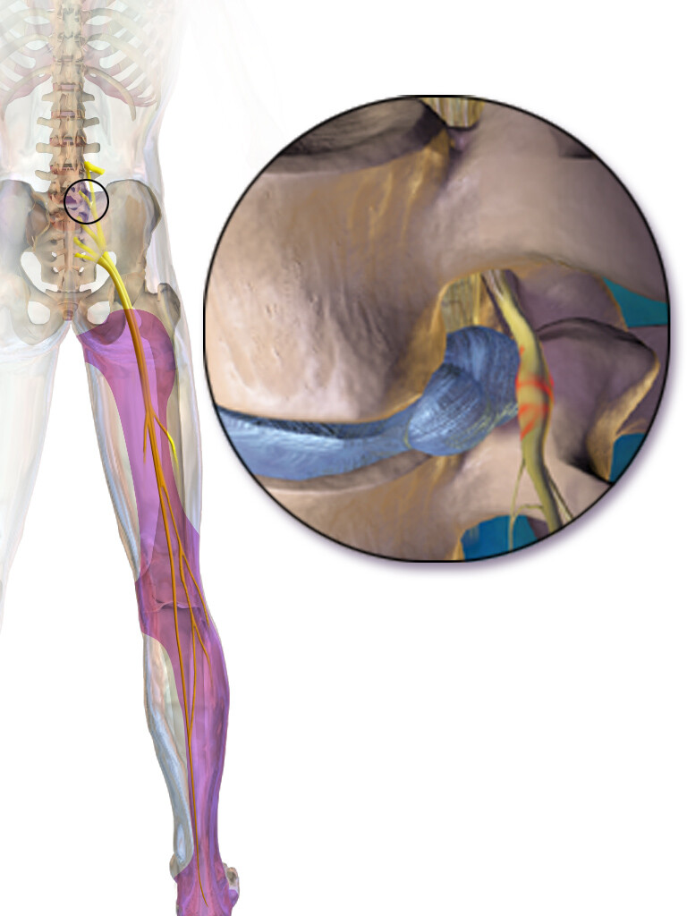 Sciatica - StoryMD