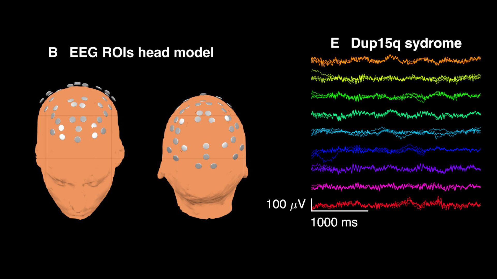 15q11-q13-duplication-syndrome-storymd