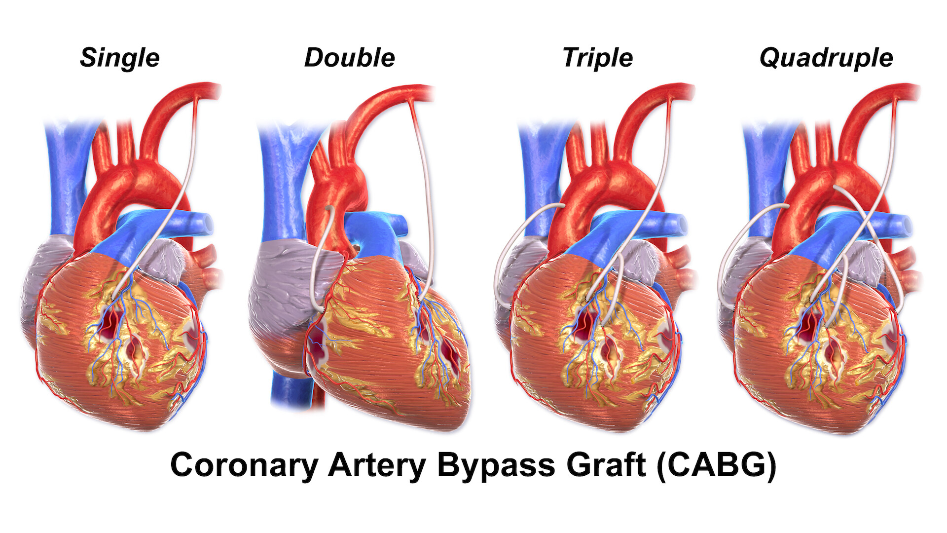 Who May Benefit From Coronary Artery Bypass Grafting StoryMD who-may-benefit-from-coronary-artery-bypass-grafting-storymd