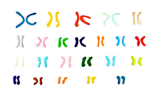 XLinked Spondyloepiphyseal Dysplasia Tarda StoryMD