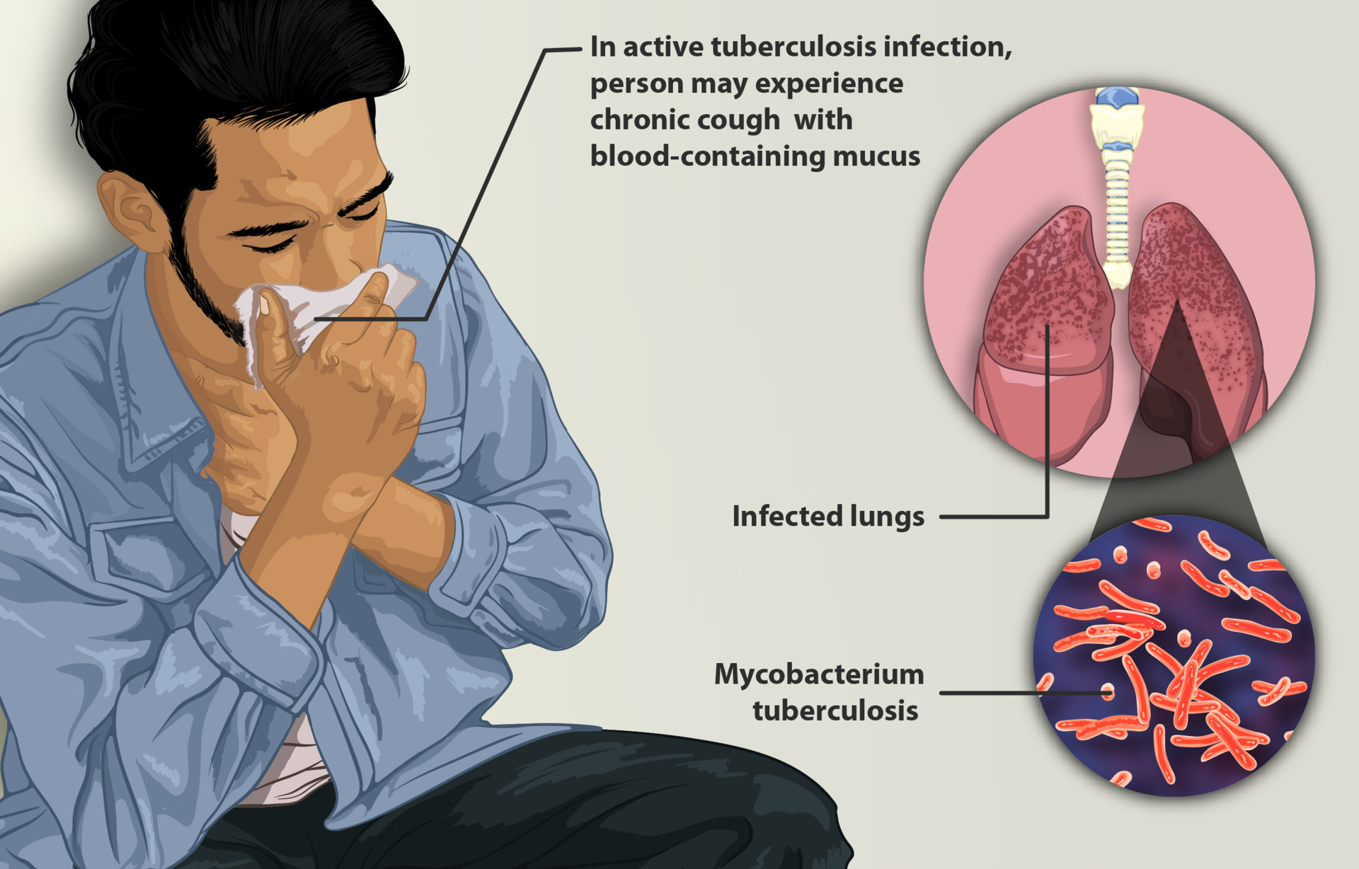 Микобактерия туберкулеза. Туберкулез tuberculosis