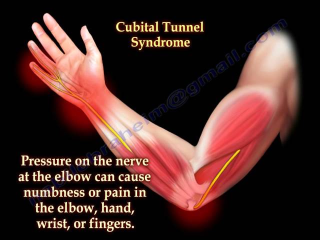 Cubital Tunnel Syndrome - Everything You Need To Know - Dr. Nabil