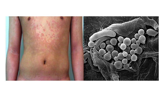 tinea versicolor melanotan Versicolor: Symptoms, Causes & Treatments Tinea Versicolor | Treatment and