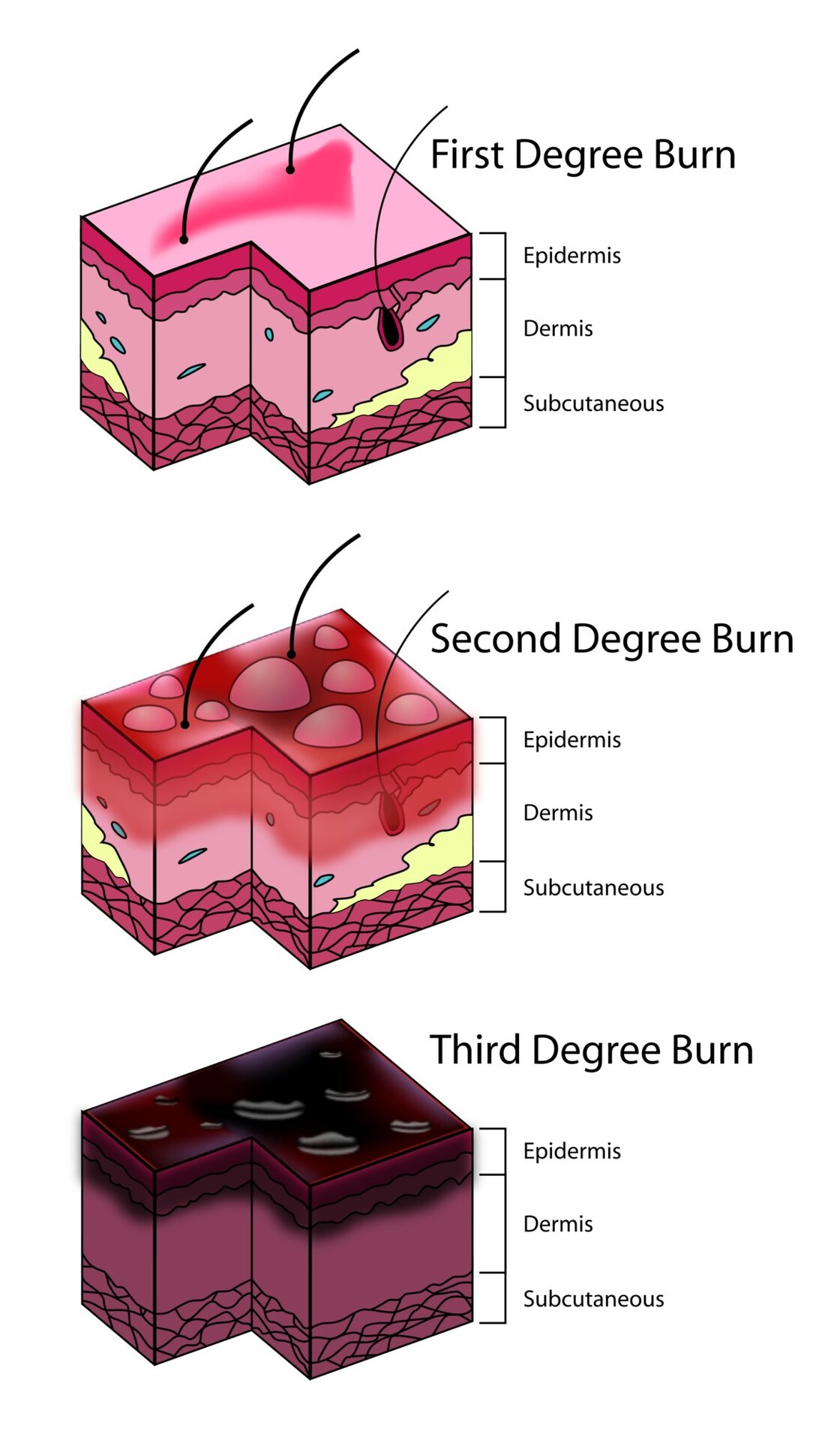 how-does-the-body-react-to-a-severe-burn-storymd