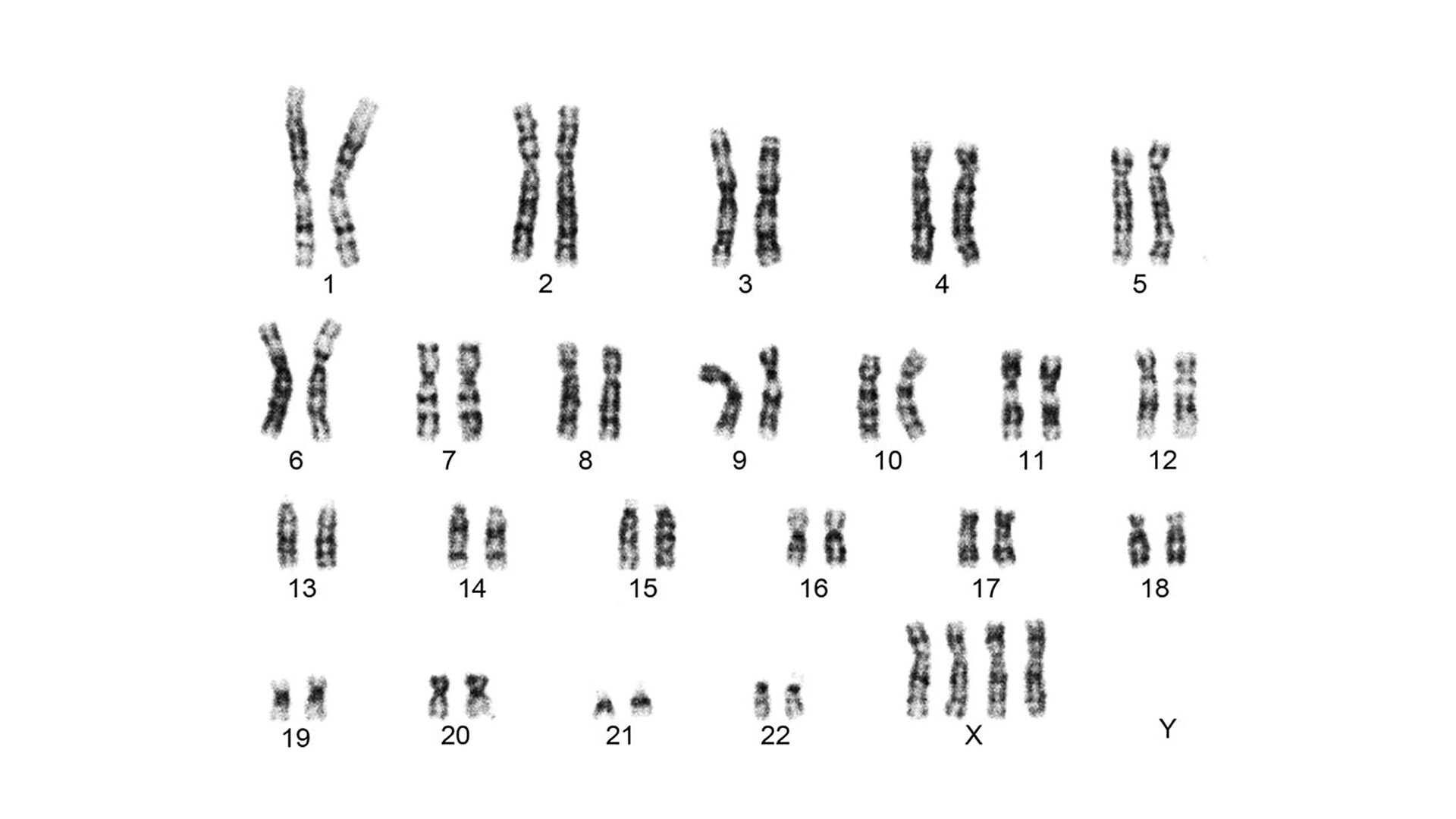 Tetrasomy X - StoryMD