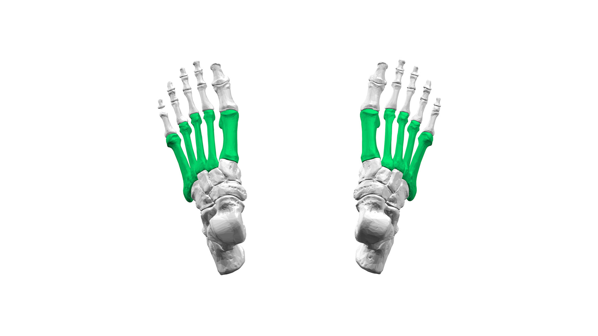 Spondyloepiphyseal Dysplasia with Metatarsal Shortening - StoryMD