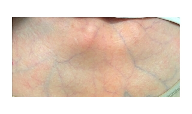 Sindrome Vascular De Ehlers Danlos Ehlers Danlos Syndrome | EDS