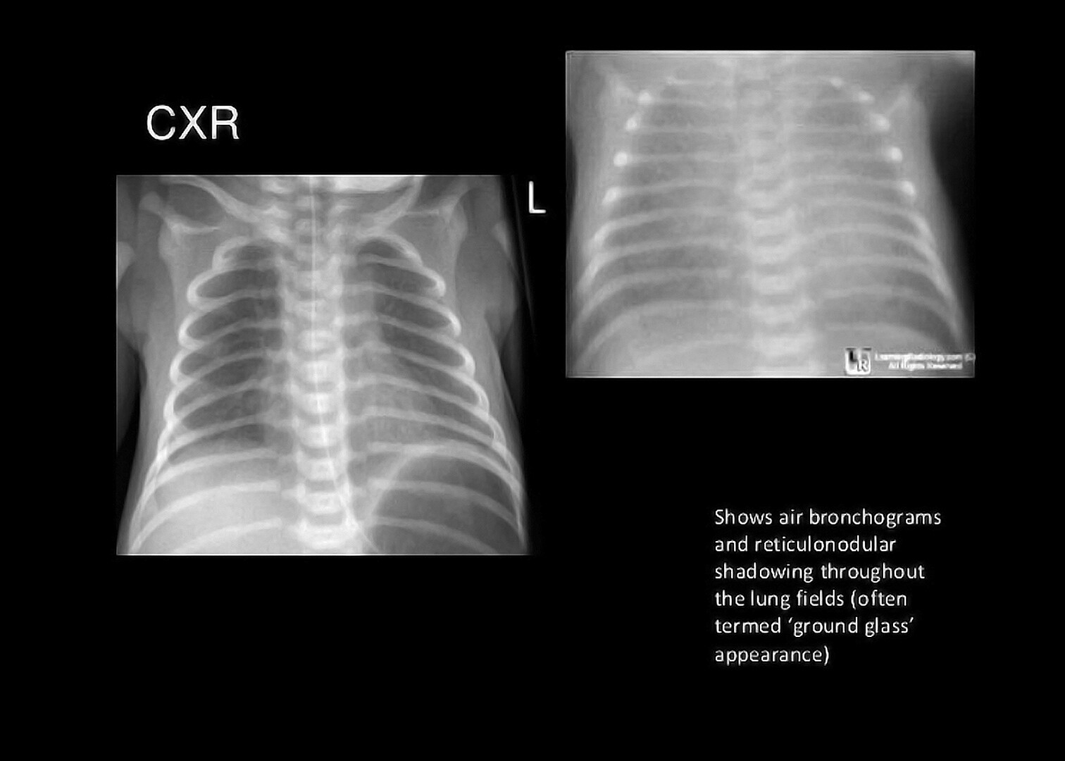Respiratory Distress Syndrome Ground Glass Neonatal COVID 19