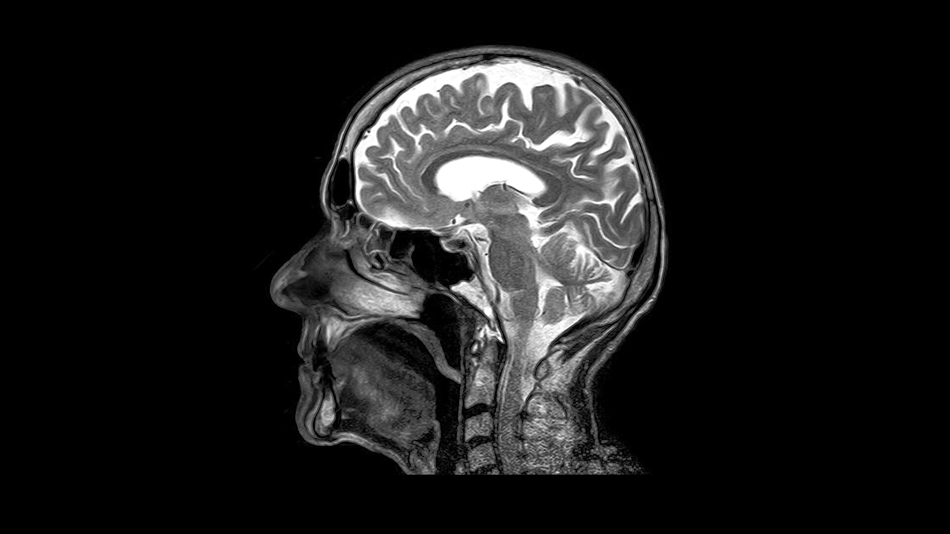 Sagittal View Of Brain Mri 4194