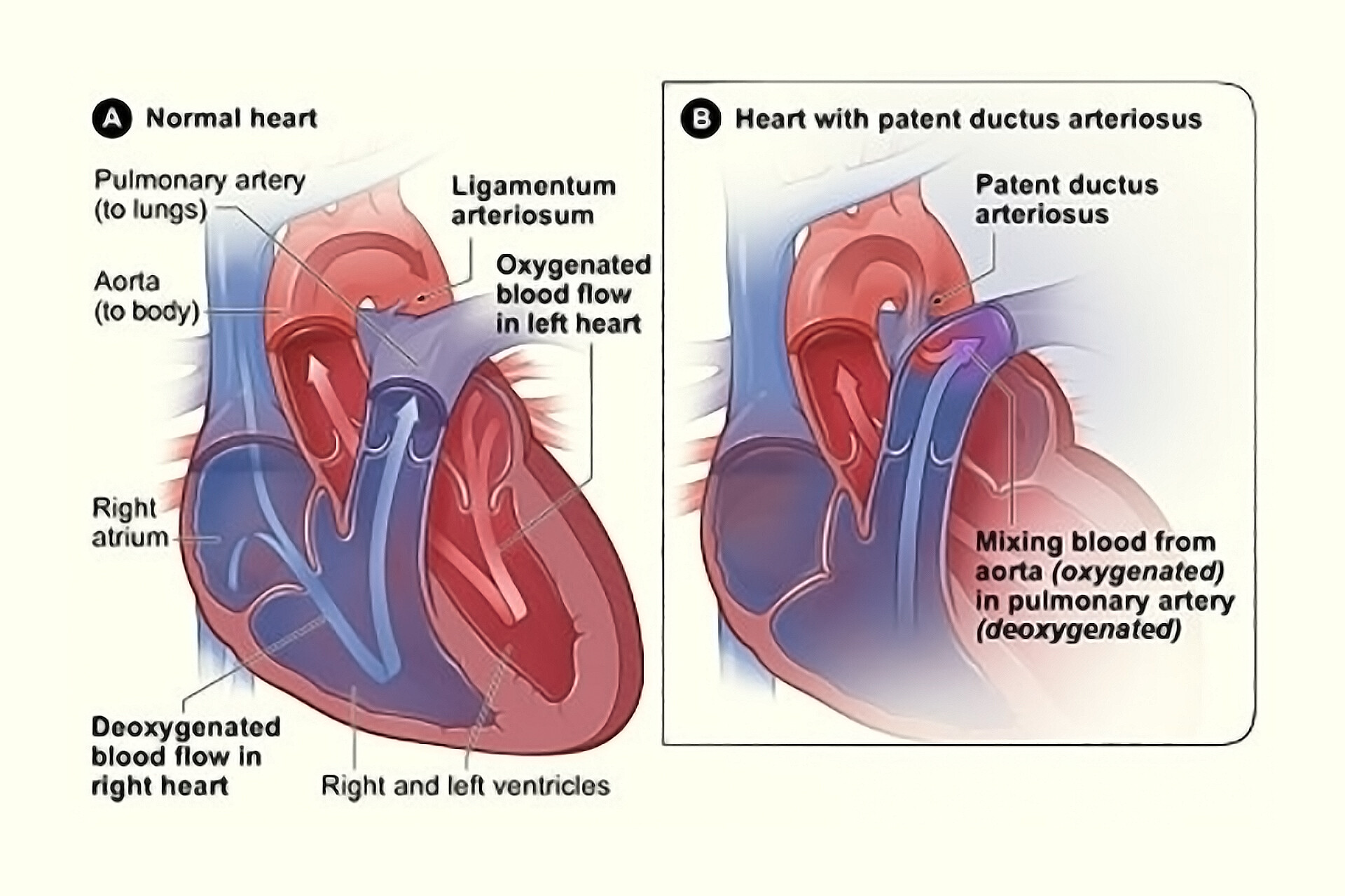 What Is Patent Ductus Arteriosus? StoryMD