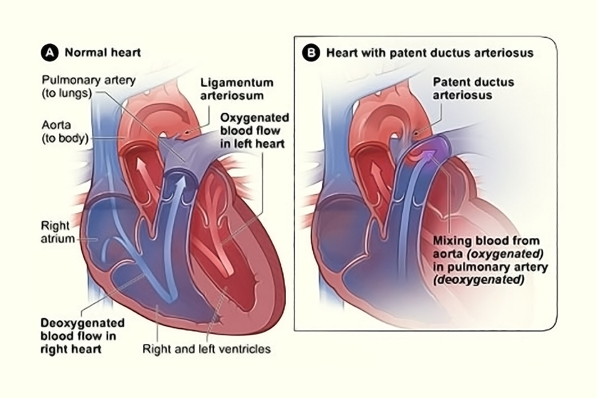 Ligamentum Arteriosum Ductus Arteriosus Anatomy Funct Vrogue co