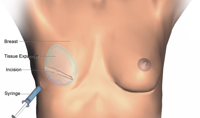 Breast Tissue Expanders StoryMD