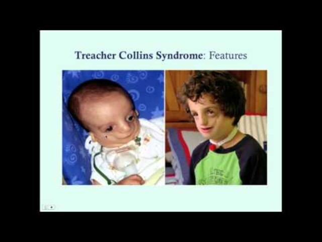 Alvorlig Treacher Collins Syndrom Treacher Collins Syndrom: Jono