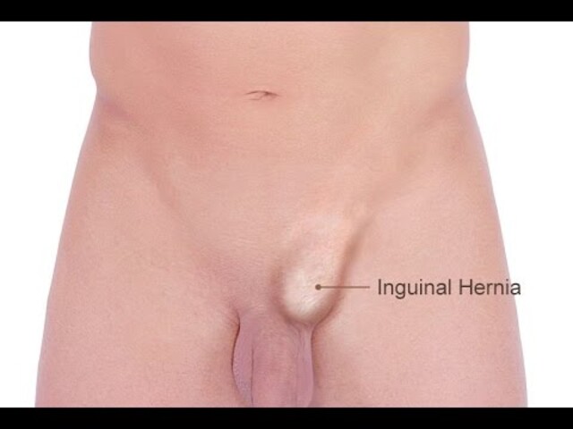 What Is an Inguinal Hernia? - StoryMD