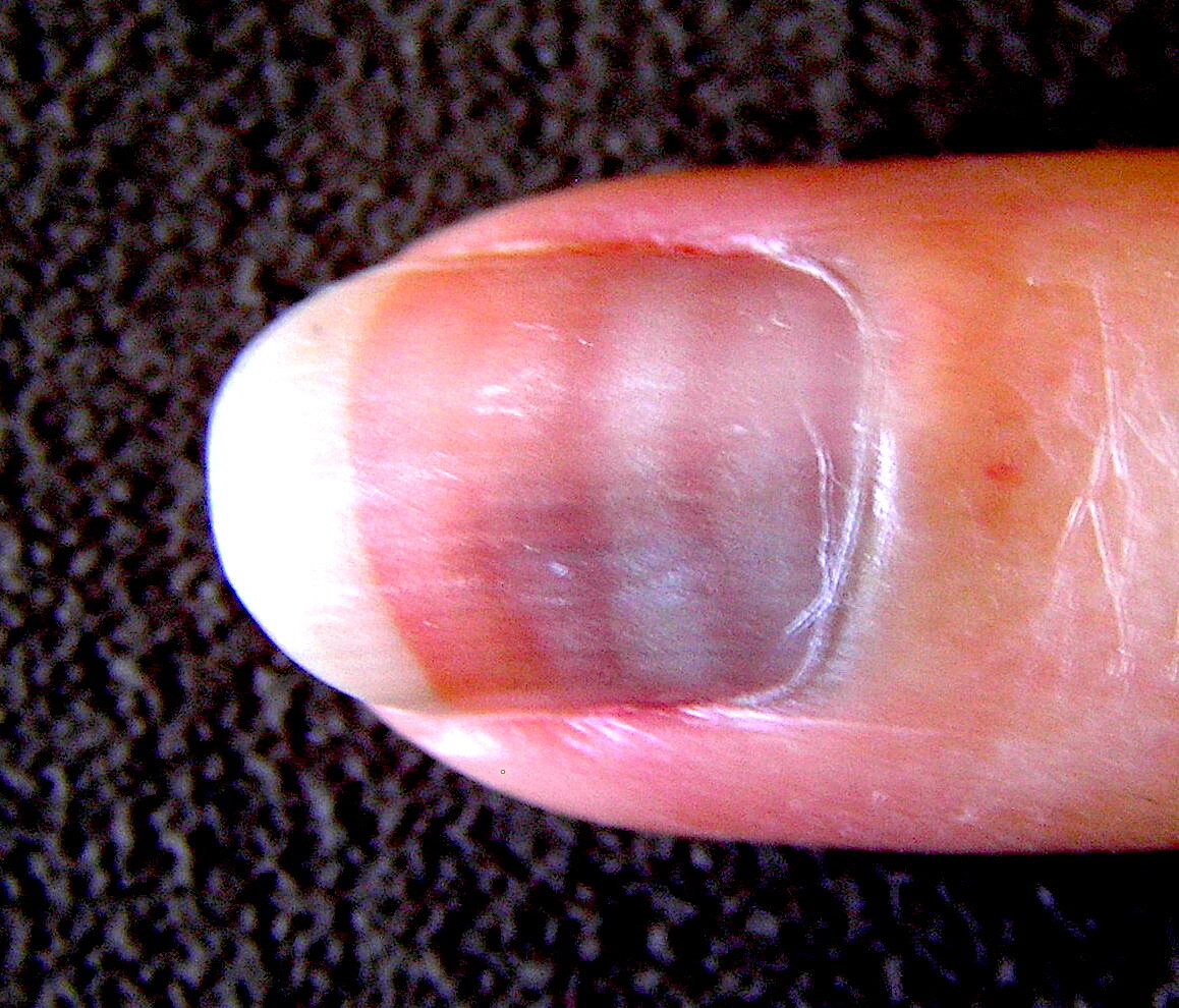 nail pitting psoriasis｜TikTok Search