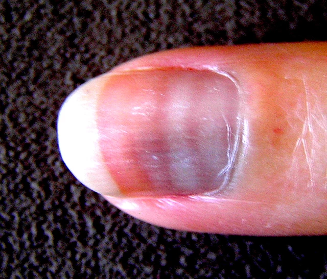 Funky Fingertips? What Nails Say About Your Health - StoryMD