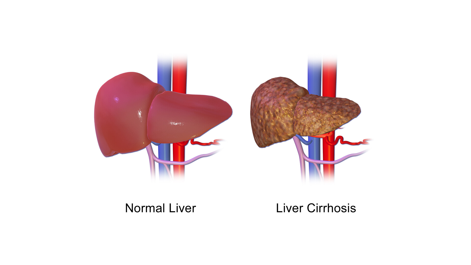 Alcohol Dehydrogenase Test: Why Is It Done and What the Results Mean ...