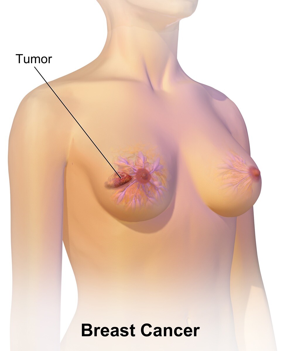 The ABCs of Breast Cancer: Understanding the Different Types - StoryMD