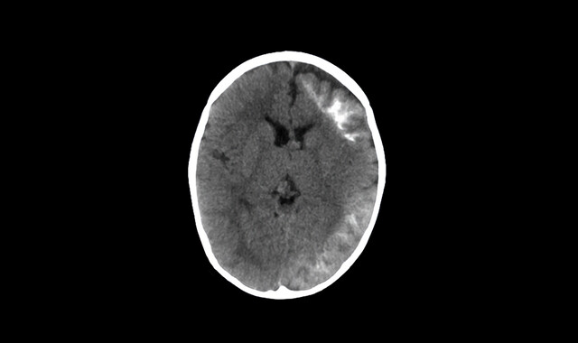 Sturge-Weber Syndrome (SWS): Causes, Symptoms, Treatment - StoryMD