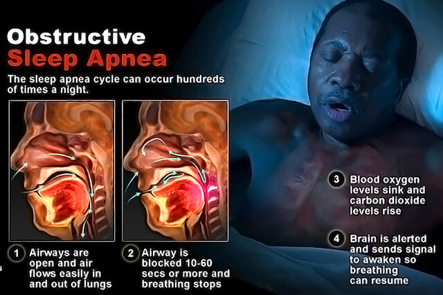What Causes Sleep Apnea? - StoryMD
