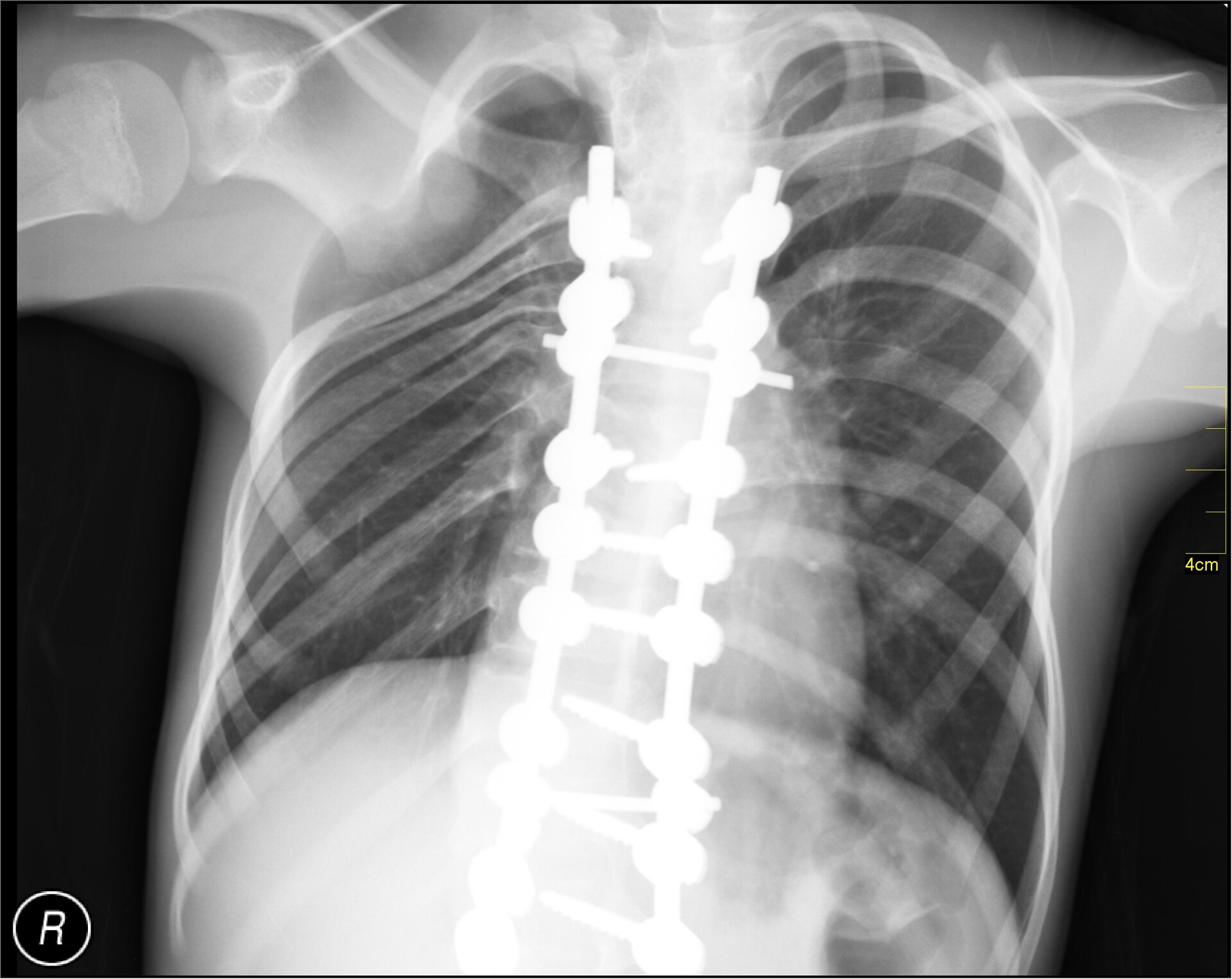 Thoracentesis - StoryMD