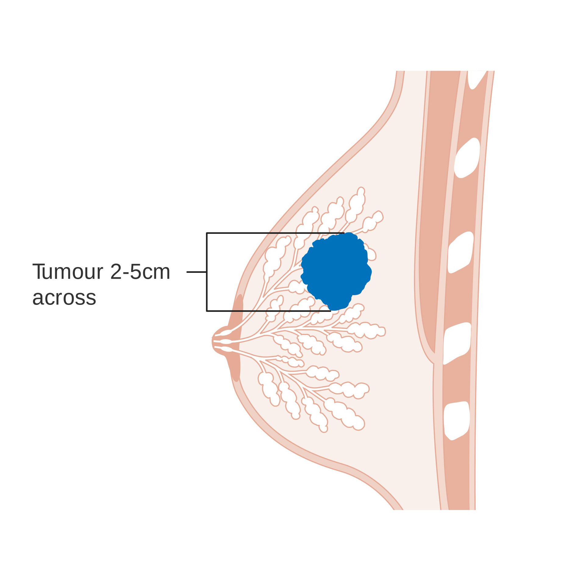 What Are the Symptoms of Breast Cancer? - StoryMD