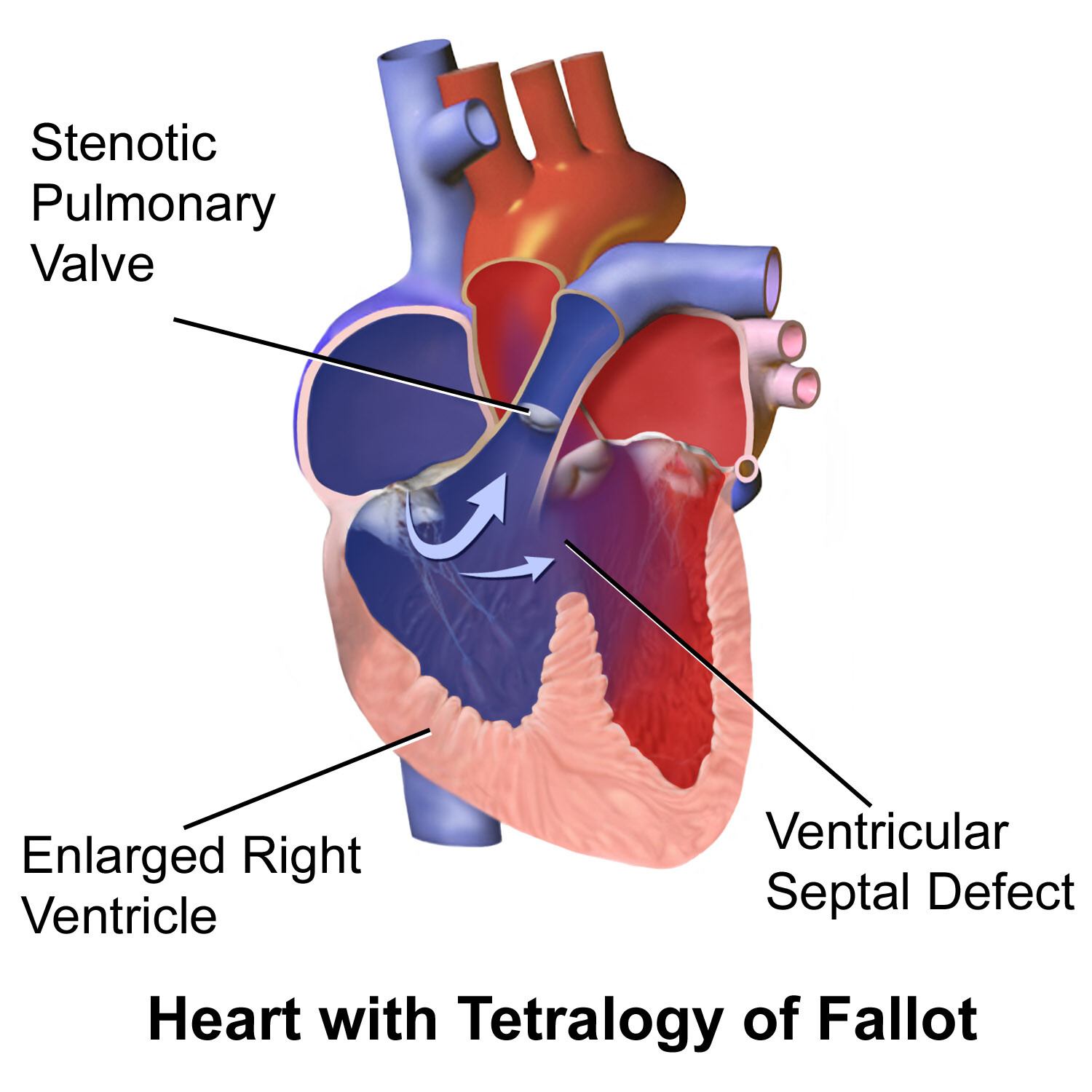 What Causes Tetralogy Of Fallot? - Storymd