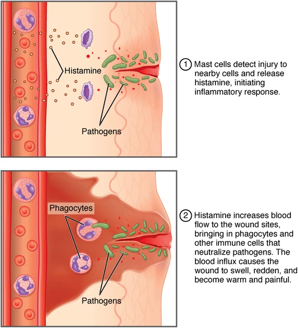 Transverse Myelitis Transverse Myelitis Neurology Medbullets Step