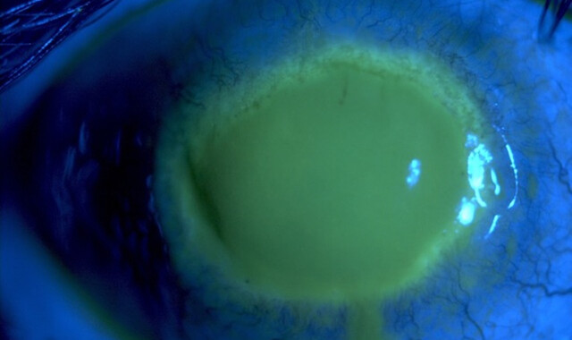 Acanthamoeba Keratitis Storymd 4388