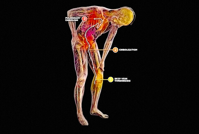 Sciatica - StoryMD