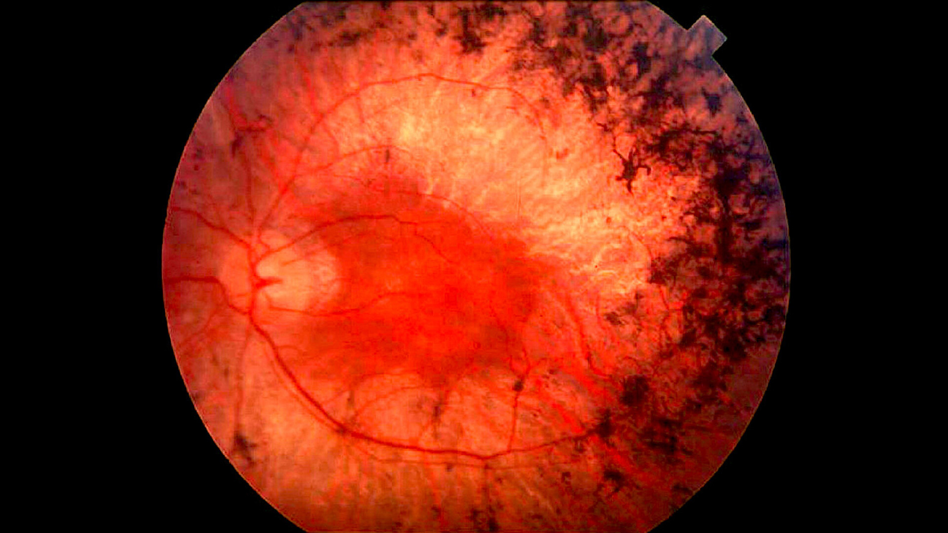 retinitis pigmentosa before and after