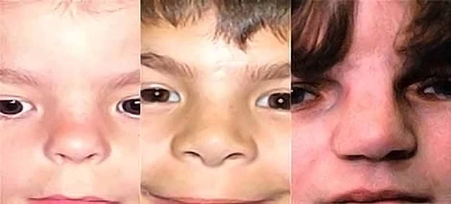 What Is Mabry Syndrome? - StoryMD