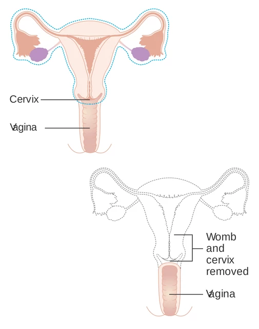 Oophorectomy Stock Vector Images - Alamy