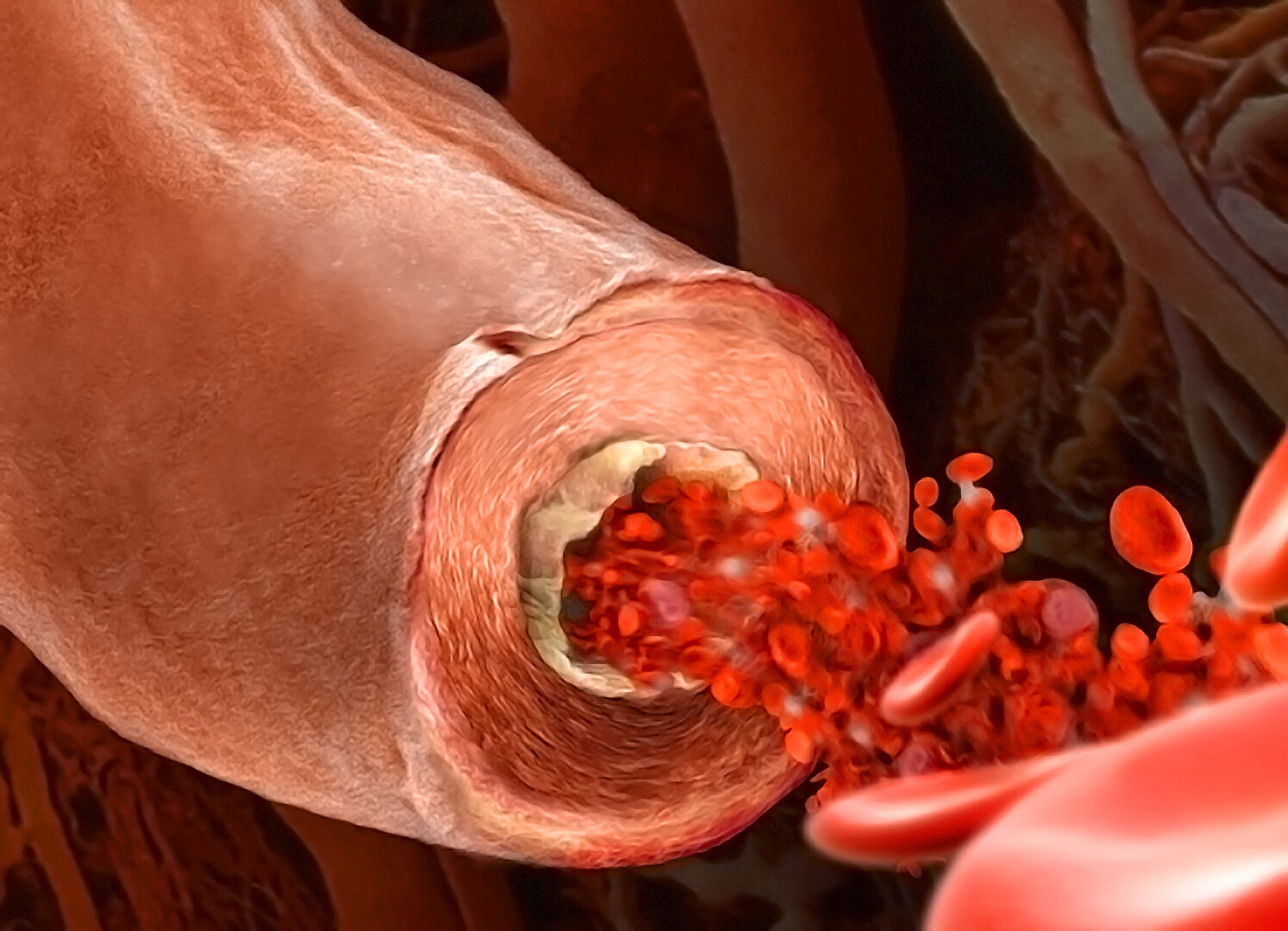 Smoking and Heart Disease Risk StoryMD