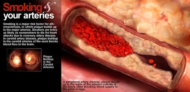 does tobacco constrict blood vessels Smoking and Vascular Disease How do nicotine-free e-cigarettes affect