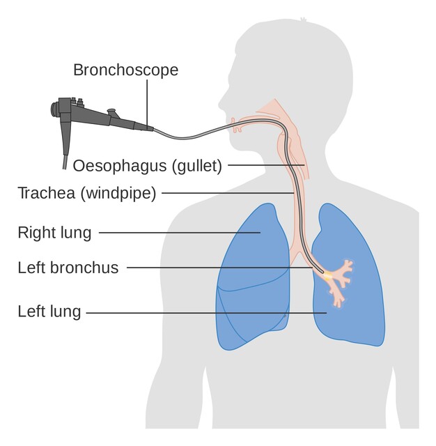 Thoracentesis - StoryMD