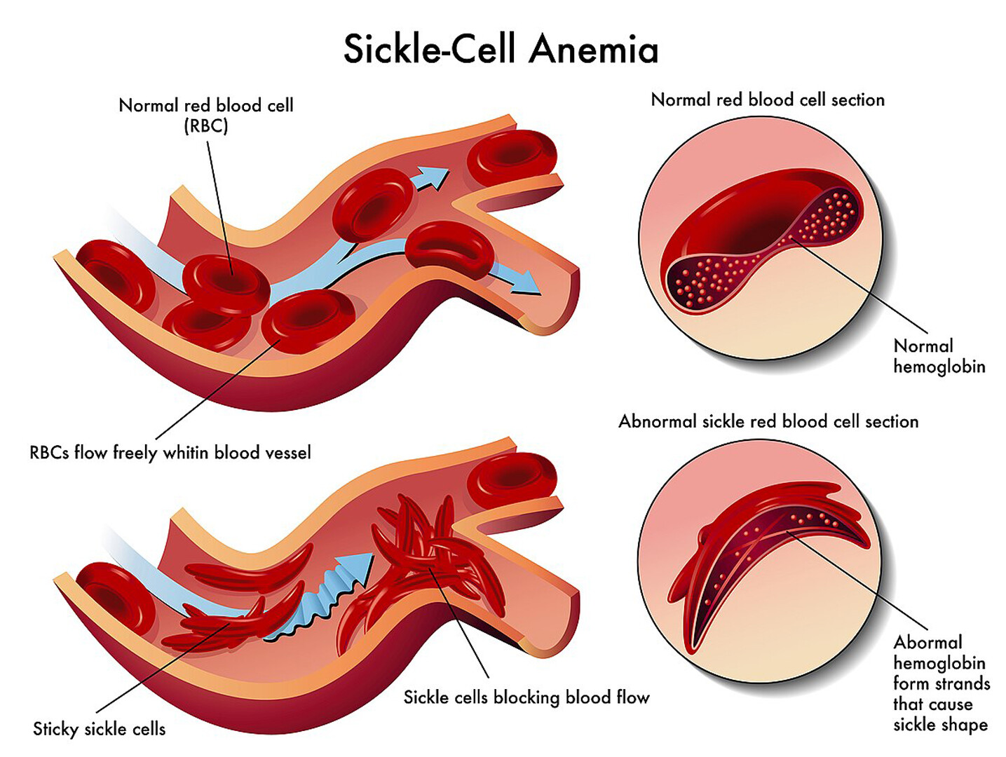 What Are The Signs And Symptoms Of Sickle Beta Thalassemia StoryMD what-are-the-signs-and-symptoms-of-sickle-beta-thalassemia-storymd