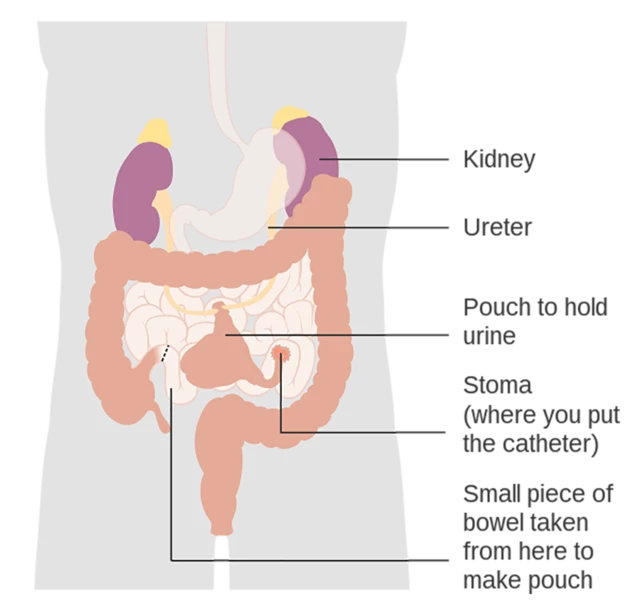 Urinary Diversion - NIDDK